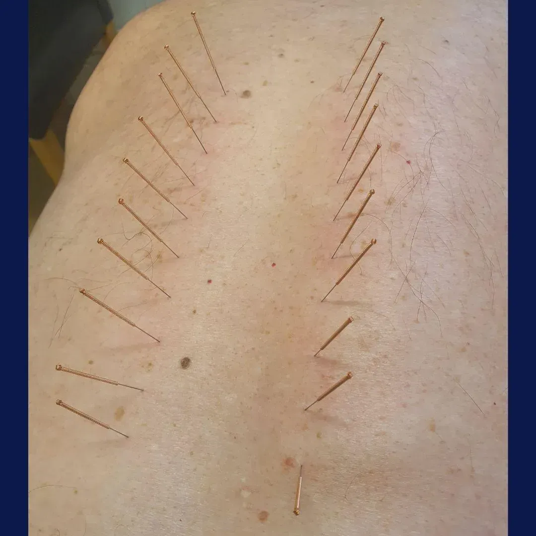 Dry needling needles along the muscles of a patient's back