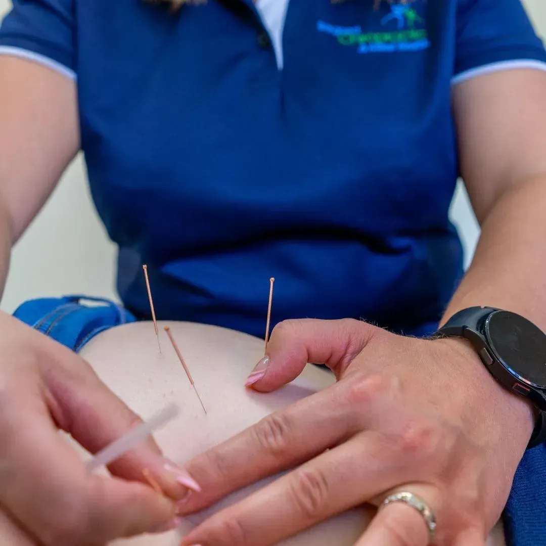 Chiropractor placing fine acupuncture needles in a patient's back at Bargoed Chiropractic
