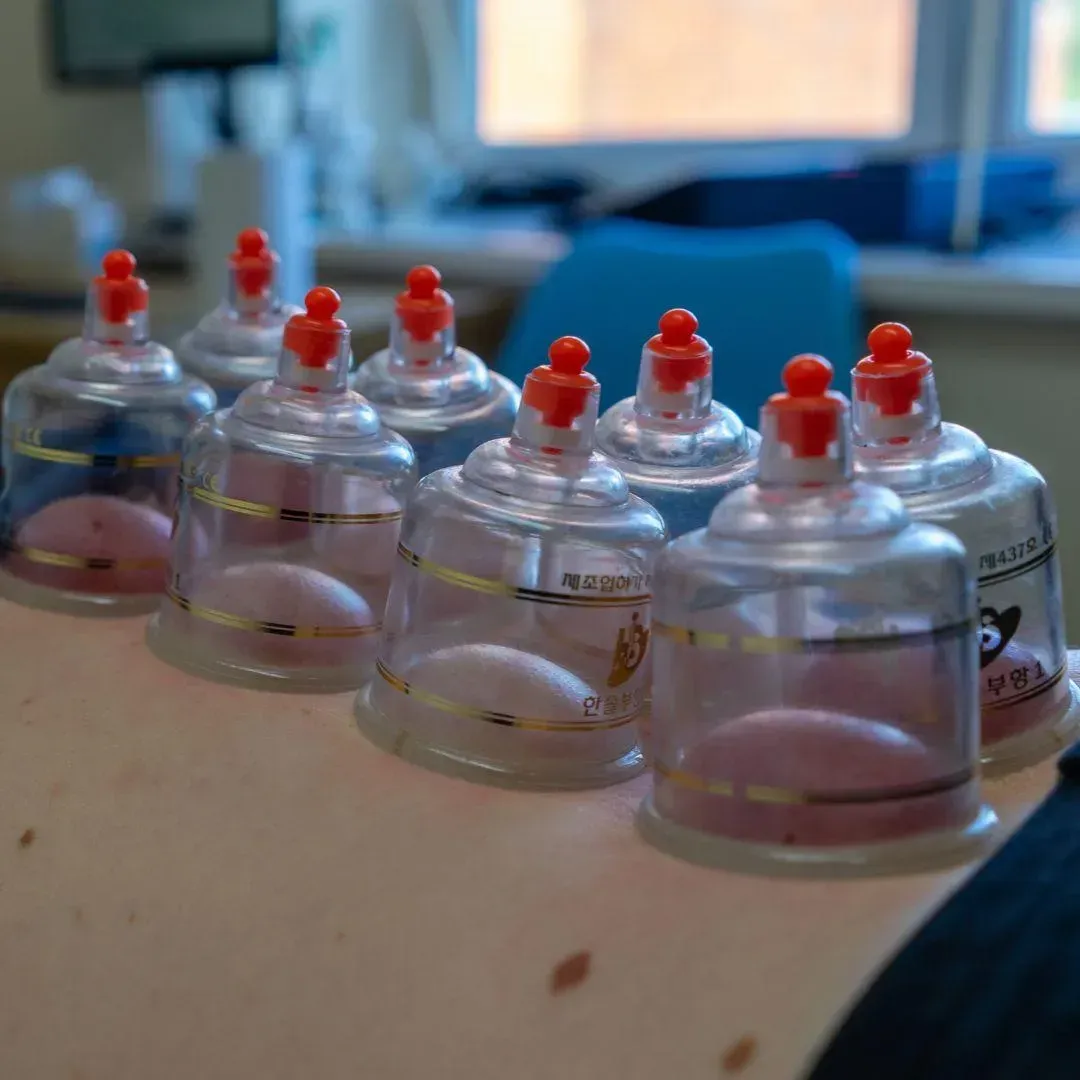 Clear cupping cups in place across a patient's back