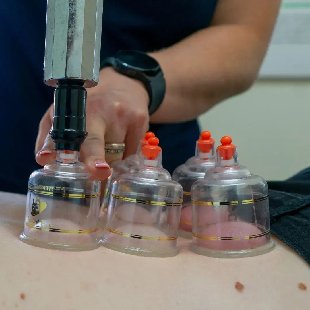 Practitioner placing cupping cups on a patient's lower back