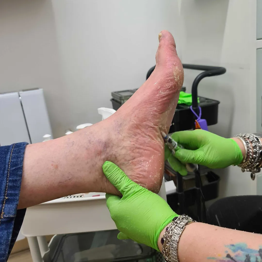 Podiatrist removing hard skin from a patient's heel