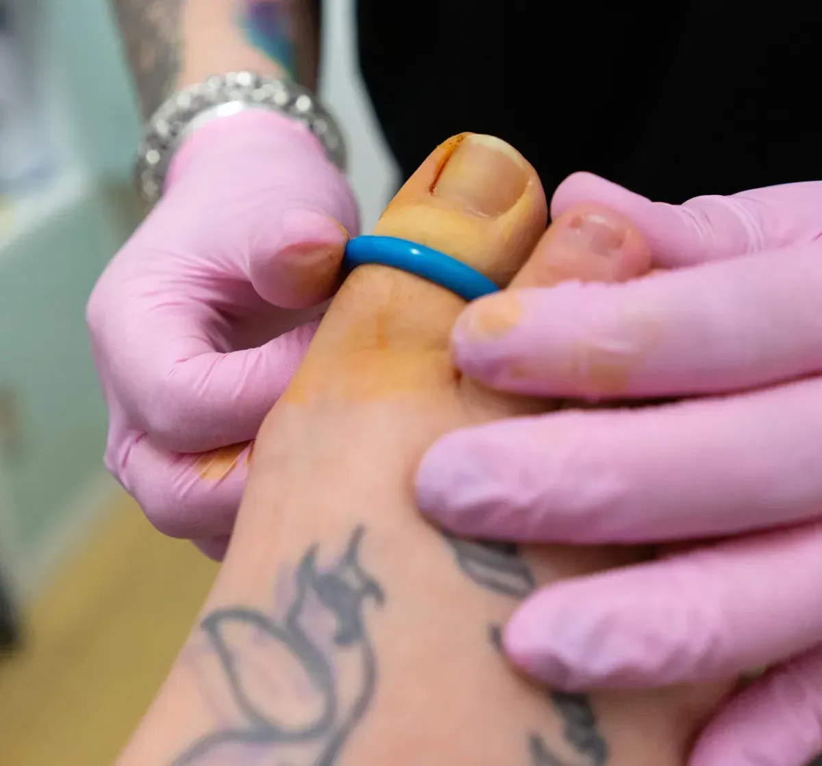 Toe with a tourniquet ring ready for ingrowing toenail surgery